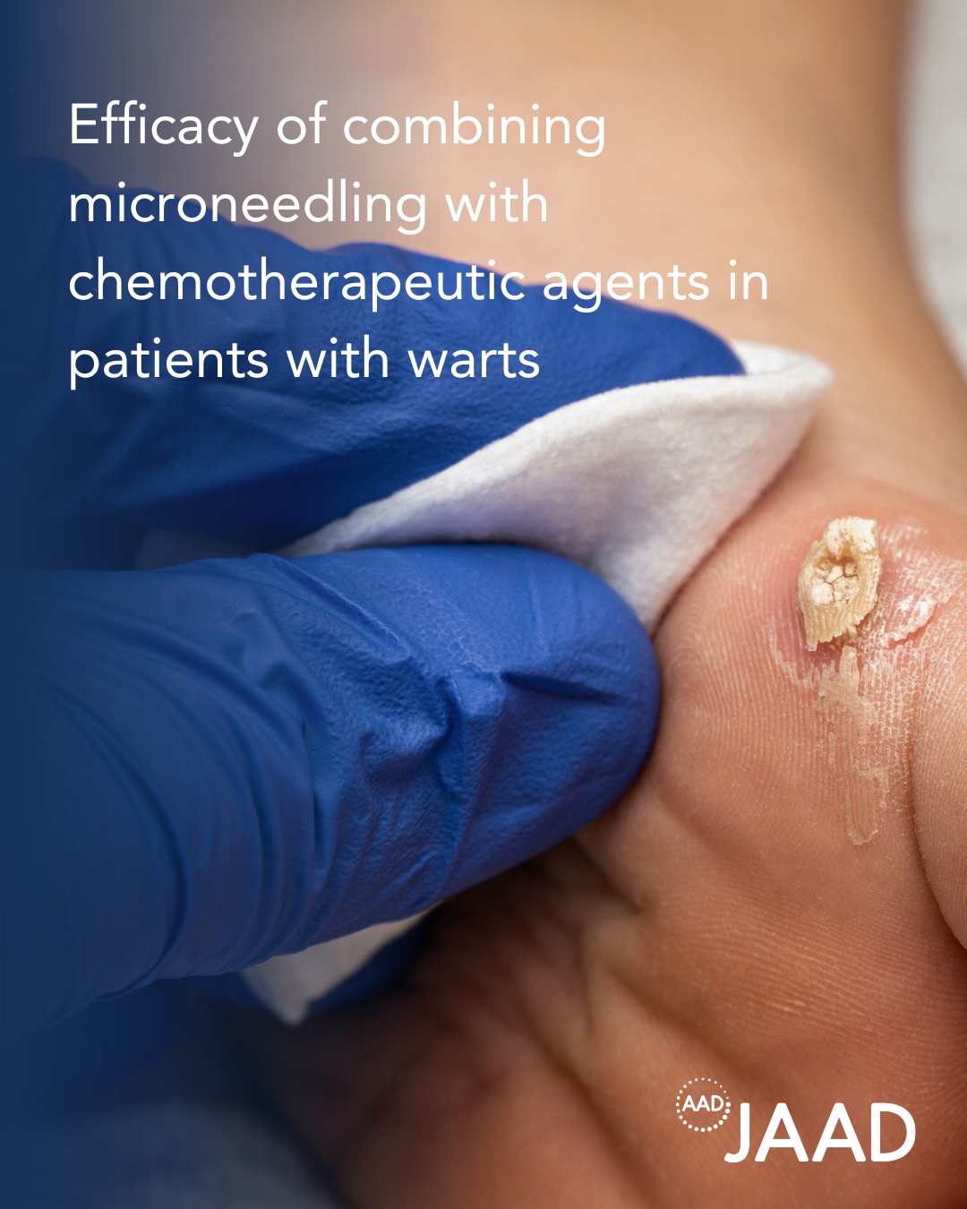 This meta-analysis evaluated the efficacy of combining microneedling with chemotherapeutic agents for the treatment of cutaneous warts. Results suggest that combination therapy may provide improved therapeutic outcomes and fewer adverse events compared