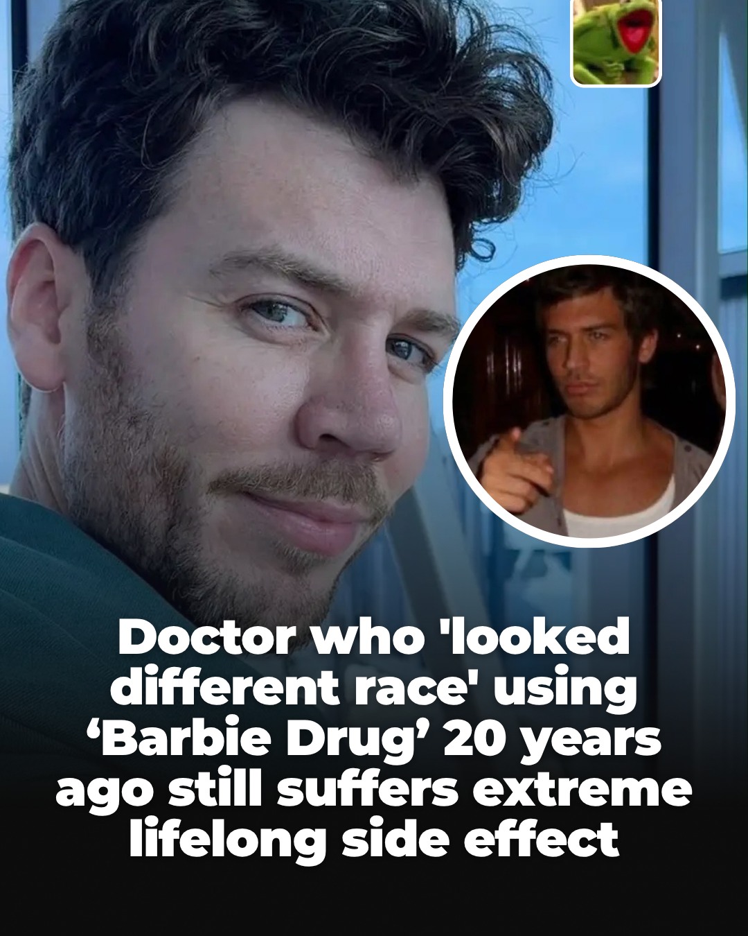 does melanotan darken eyes A doctor who used II as a young medical student 20 years ago has issued a stark warning about the unlicensed tanning peptide, revealing he is still living with the consequences GSWP 4x Kojic Acid Flavor:Tangy Orange 30 VC
