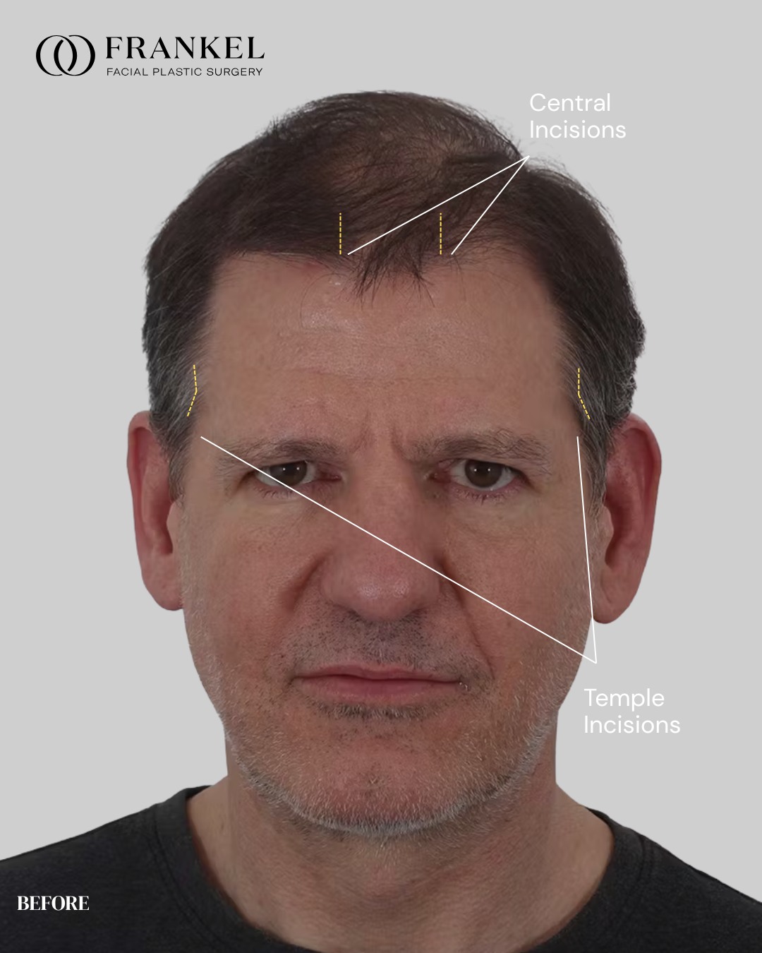 This diagram shows the two key areas where incisions are typically made ...