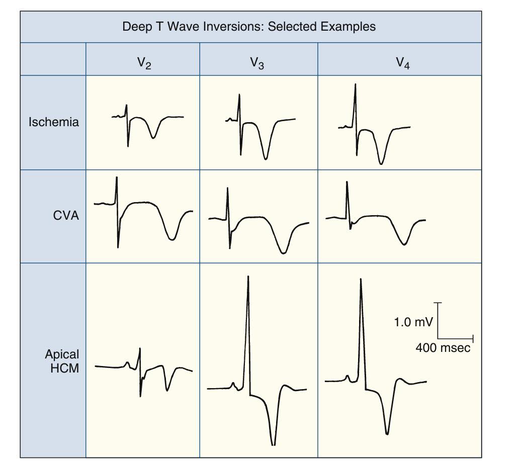 Cardionotes - Examples of T wave inversion In the middle... | Facebook