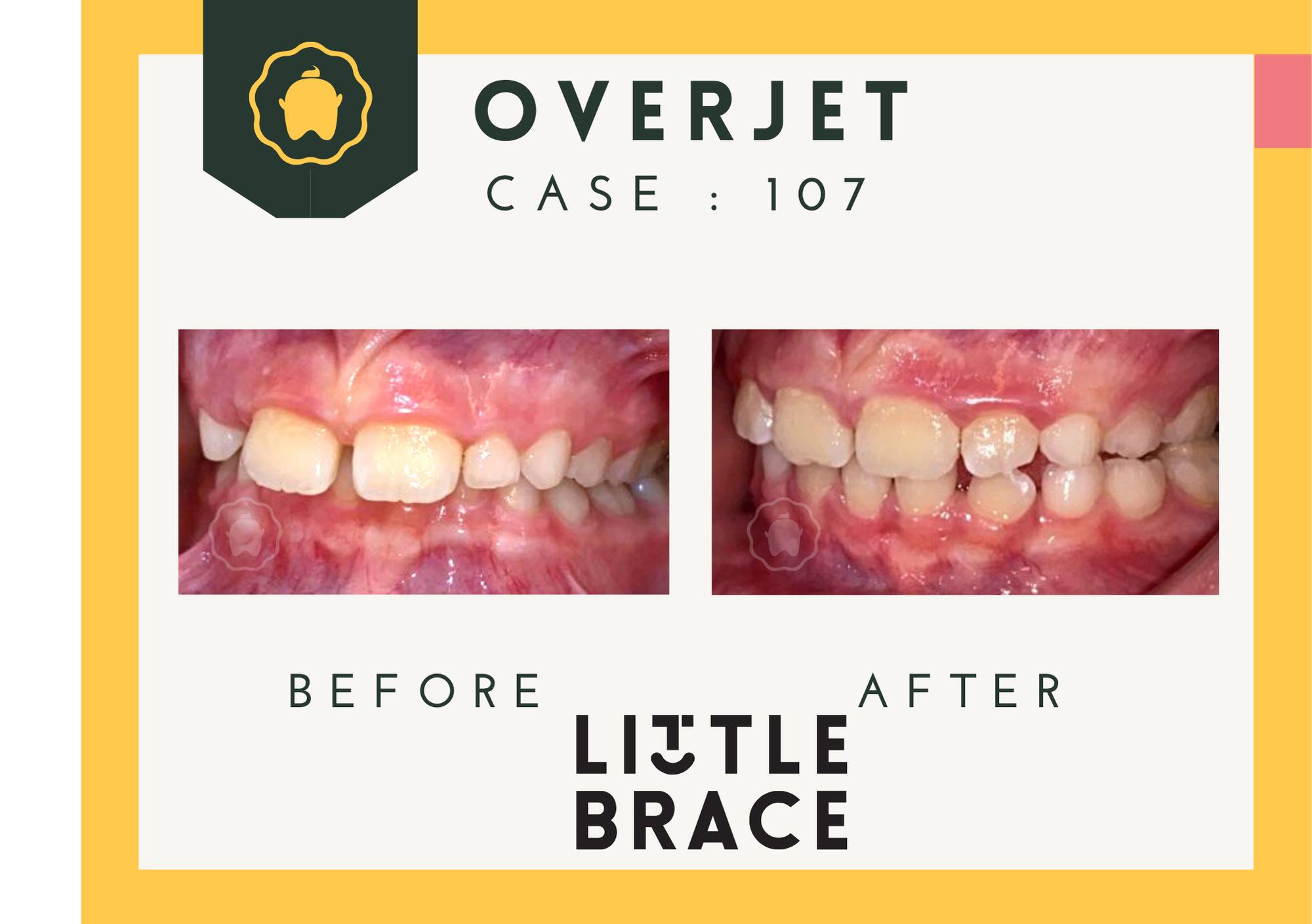 Little - An Invisalign Palatal Expander (IPE) is a custom-made, 3D ...