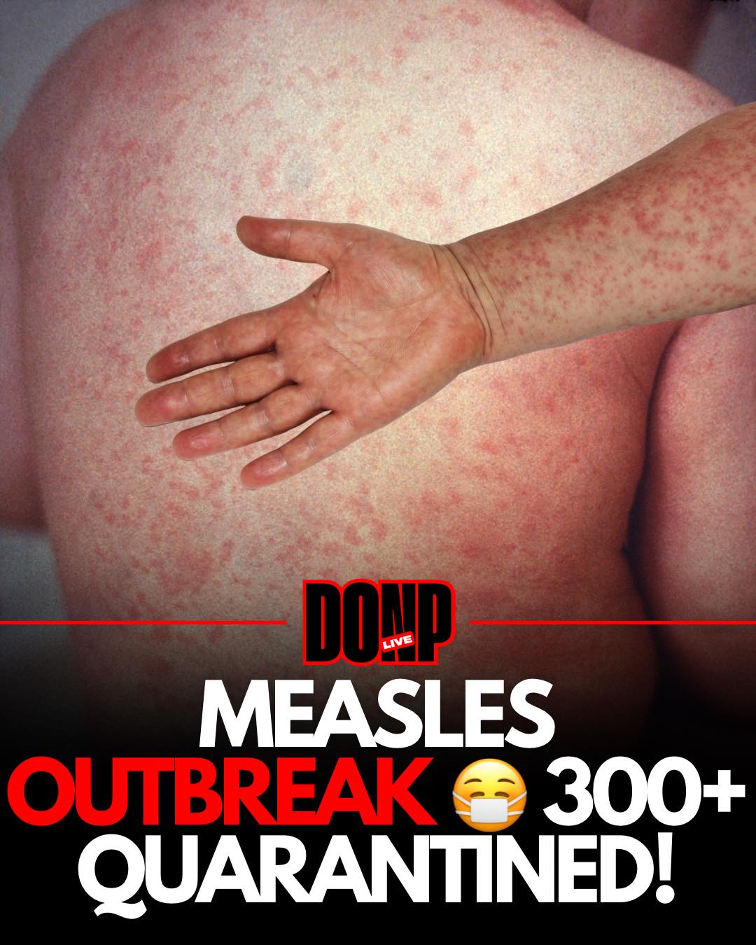 Don - South Carolina's SPIRALING into a measles NIGHTMARE in ...