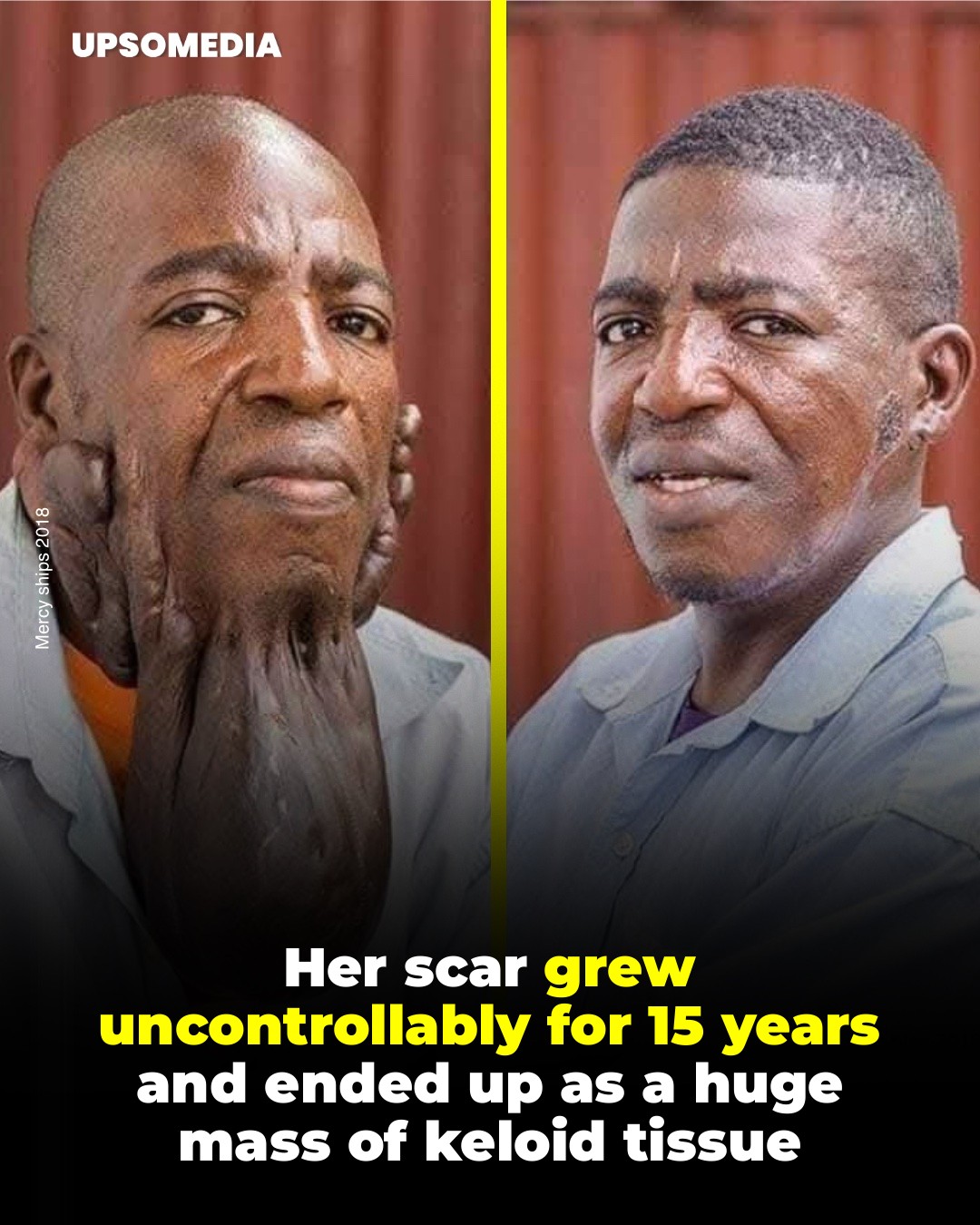 Leon, a 42-year-old cocoa farmer, lived for 15 years with a huge