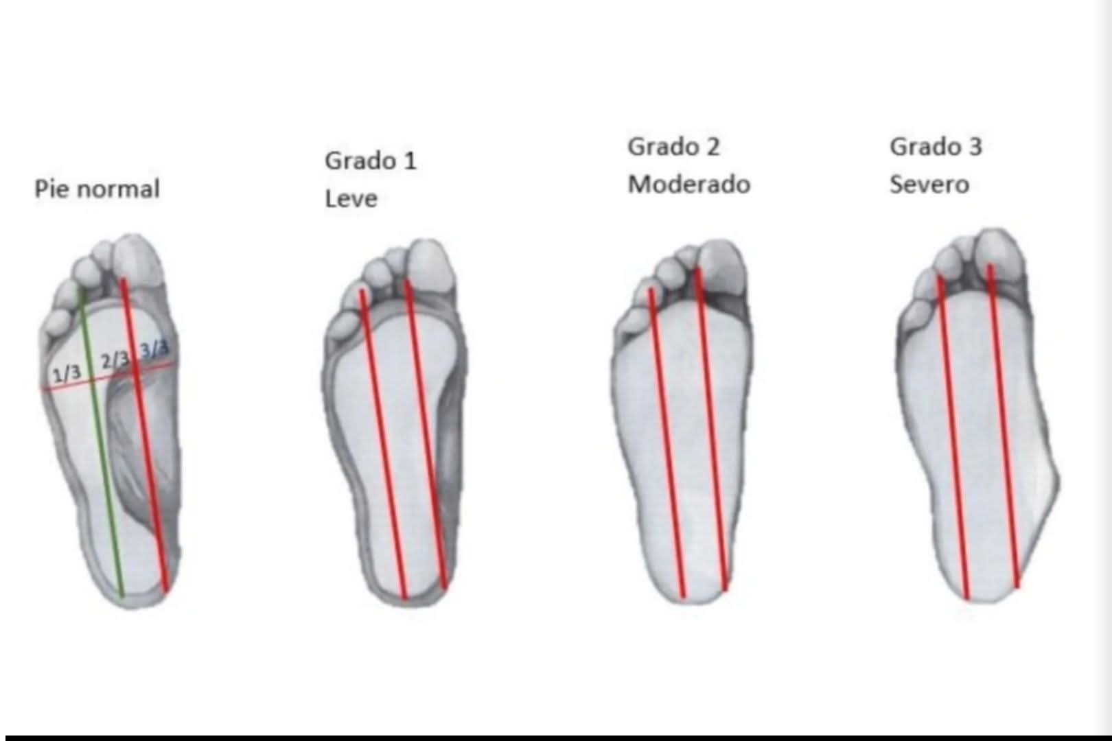 Clínica - 🦶 ¿Sabías que existen distintos grados de pie plano? En la ...