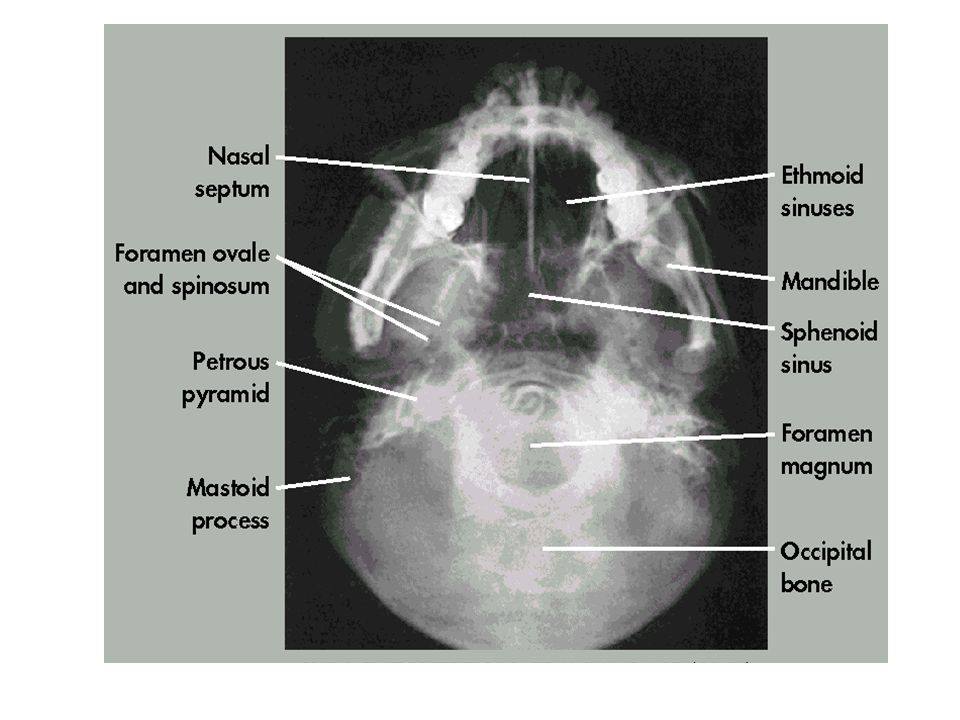 Submentovertex (SMV)... - Registered Radiologic Technologist | Facebook
