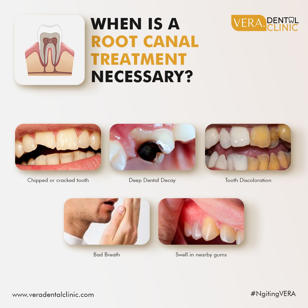 When is a root canal... - VERA. Dental Clinic - Imus | Facebook