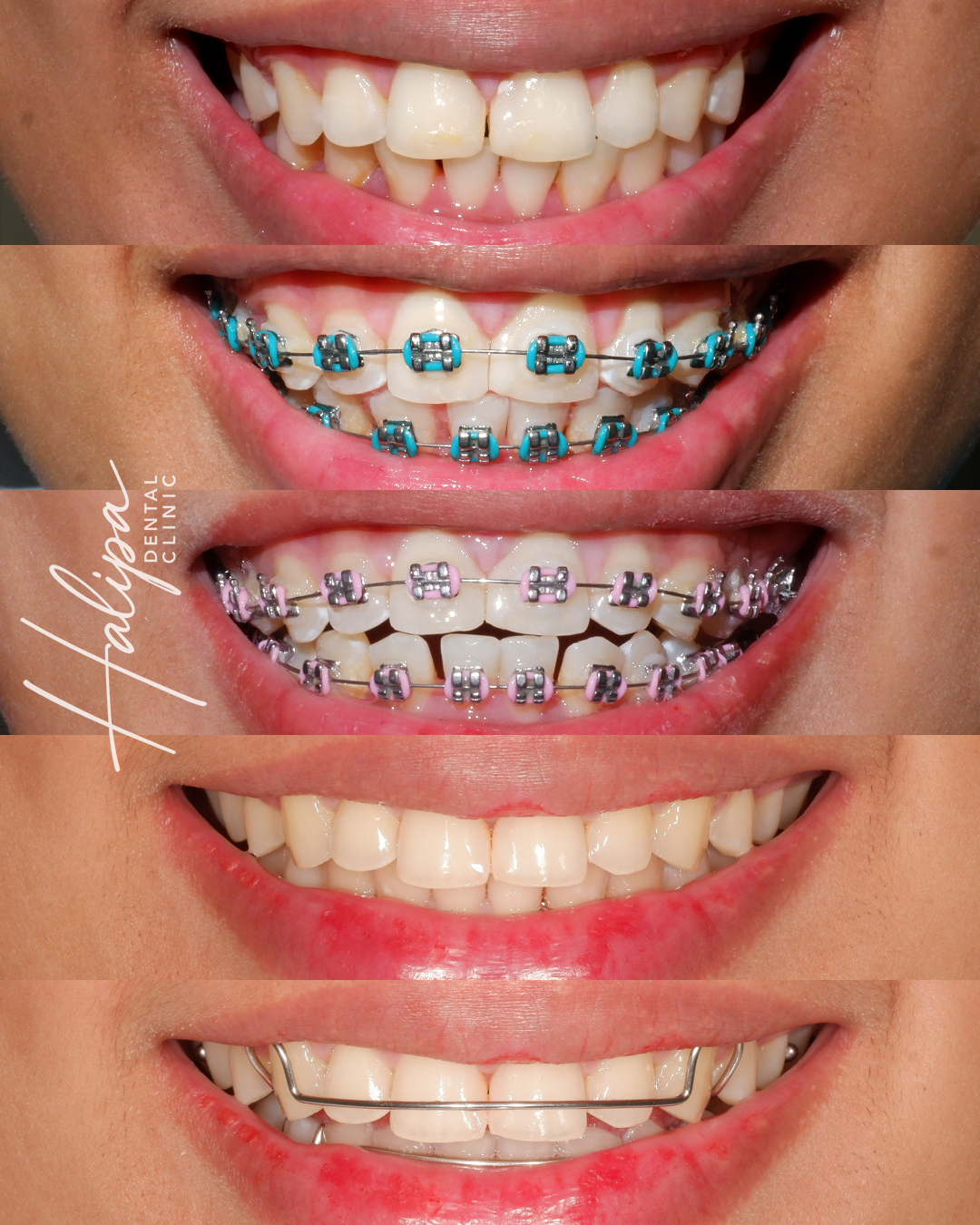 Halipa - From Day 1 to Retainers A beautiful orthodontic journey guided ...