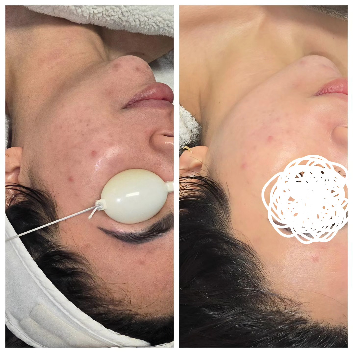 Mist - 🌹 Redness 📸 facial Not only does photofacials even tone, they ...