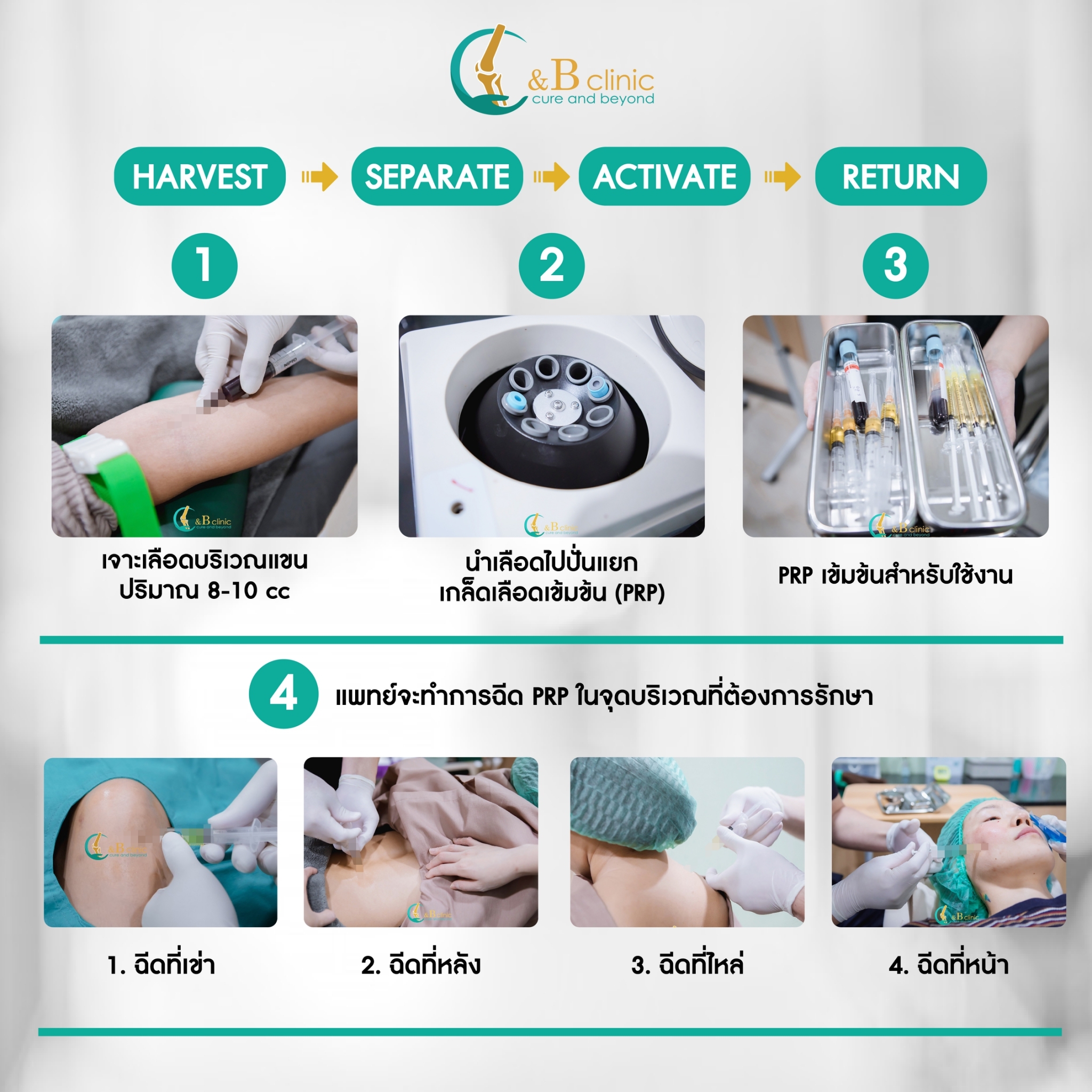 ขั้นตอนการรักษาด้วย PRP เริ่มต้นจากการเก็บเลือดประมาณ 8-10 ml แล้วนำมา ...