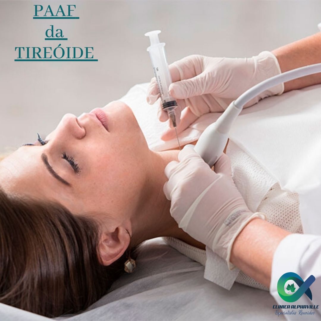 PAAF DE TIREOIDE O exame da PAAF... - clinica.alphavilleer | Facebook