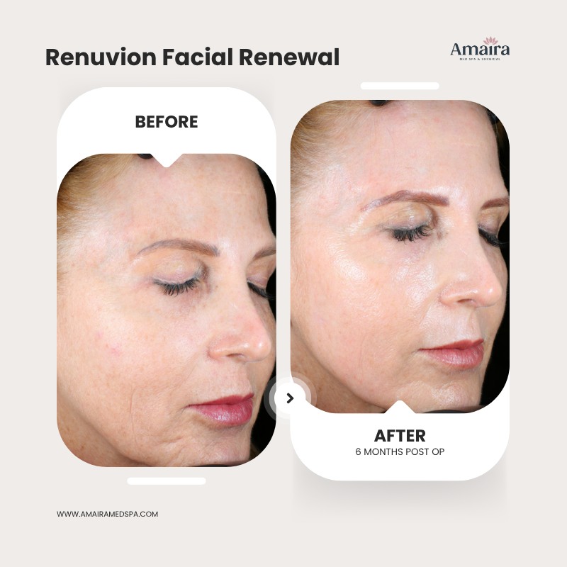 bpc 157 before and after skin BPC-157 🧬 This is your body best tool for repair! BPC-157 is known as the healing peptide. Get started on your wellness journey with us at Amaira ✨ 📍 246 NE 6th Vial