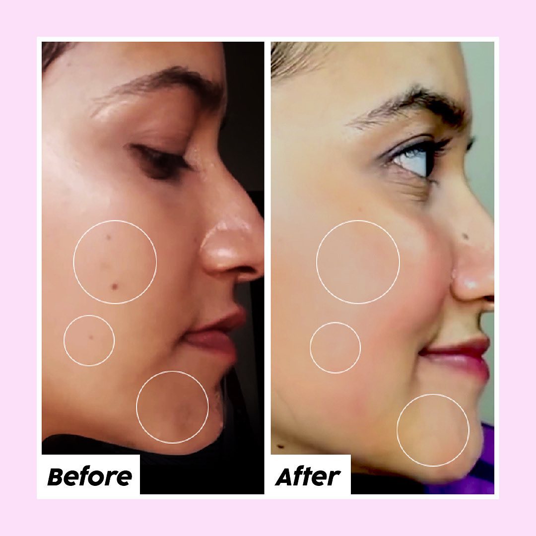 Sufia's Transformation Journey with Plix! Start your journey now with Plix Glowy Skin Glutathione. ✓ Hyaluronic Acid, Glutathione, Vitamin E, Aloe Vera & Vitamin C ✓ Clinically Backed To Reduce Melasma Production