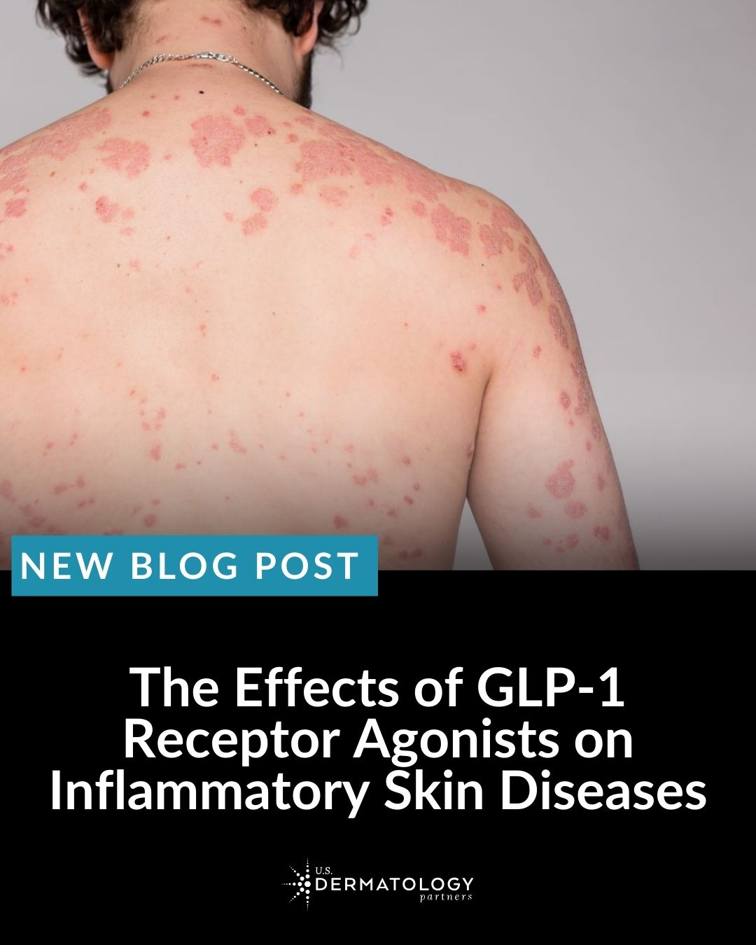 GLP-1 medications are changing... - U.S. Dermatology Partners | Facebook