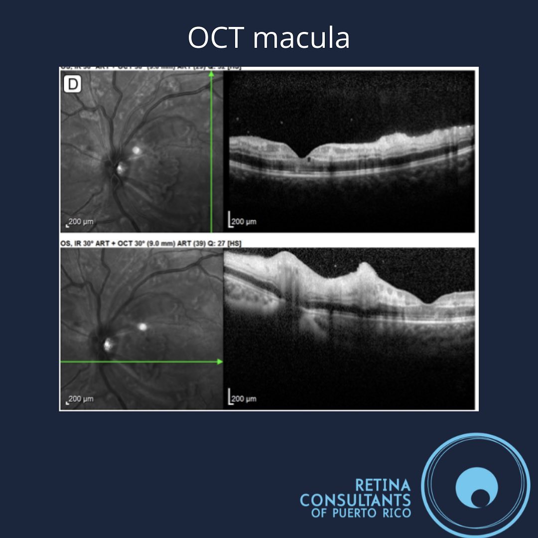 Retina Consultants PR | Puerto Nuevo