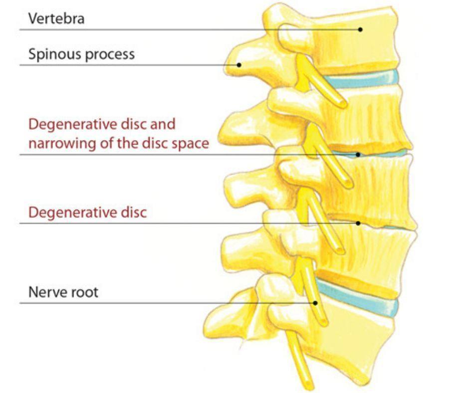 What Is Degenerative Disk... - Prime Therapy and Pain Center | Facebook