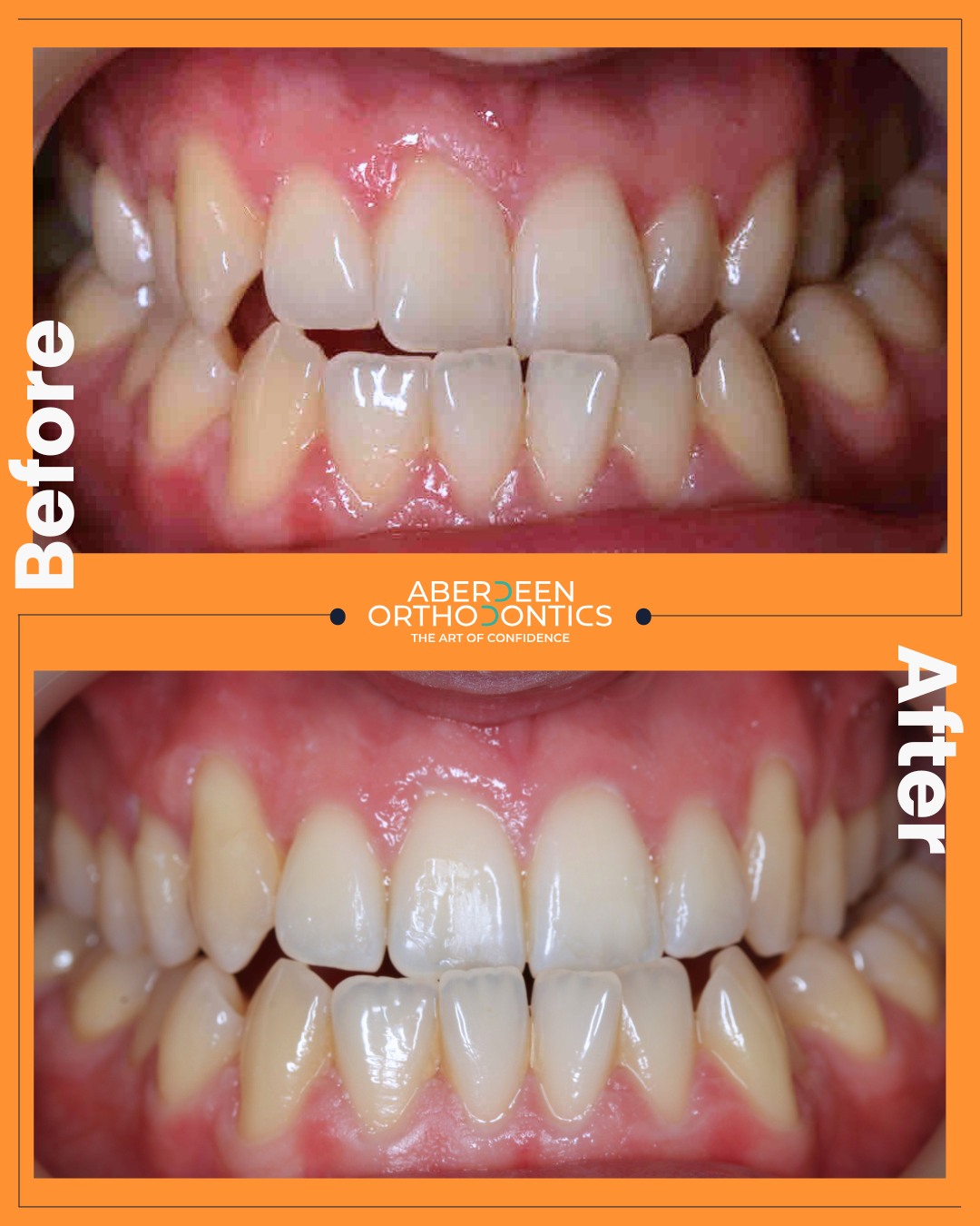 Aberdeen - This Invisalign transformation shows how clear aligners can ...