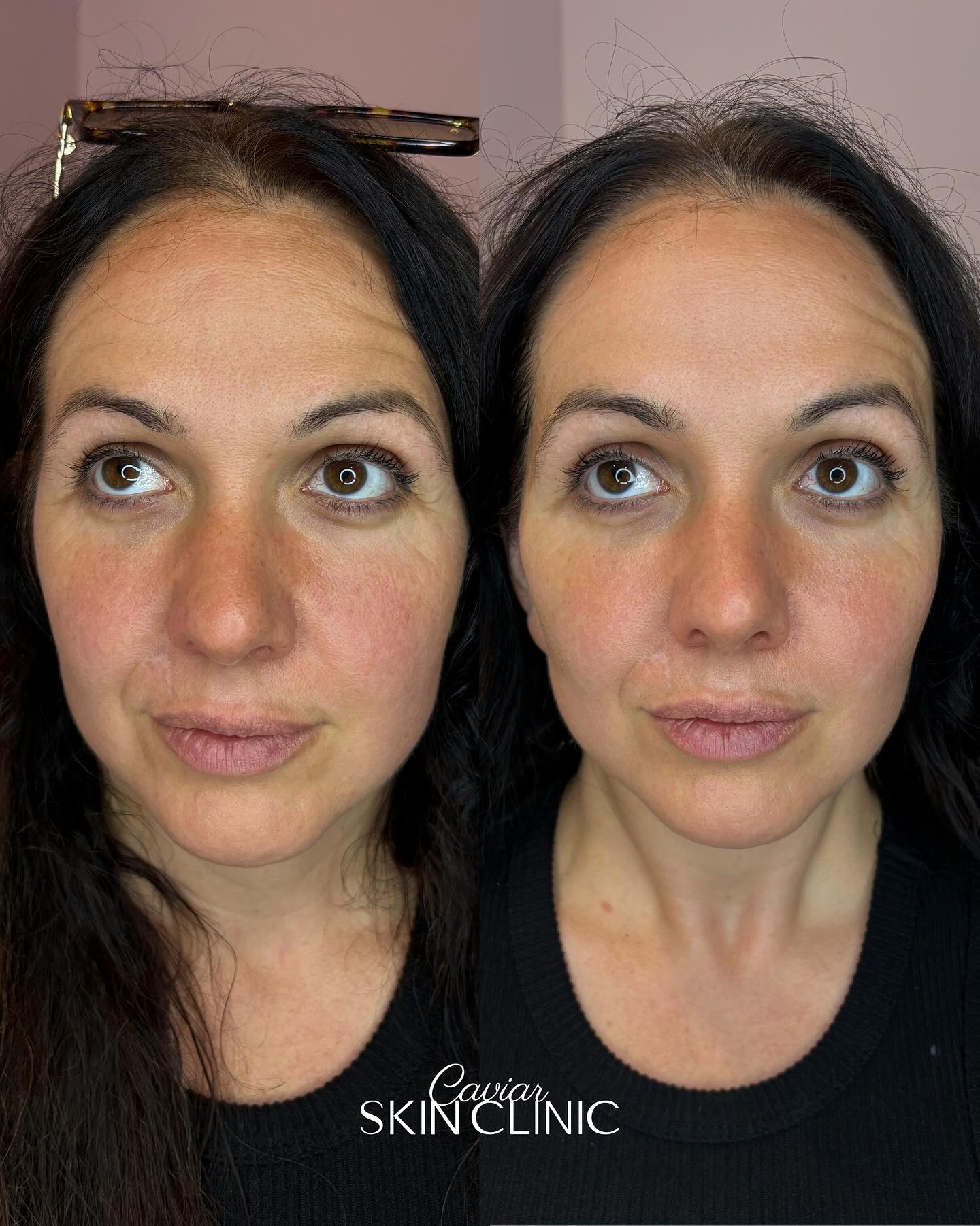 Upper face refresh in action We... - Caviar Skin Clinic | Facebook
