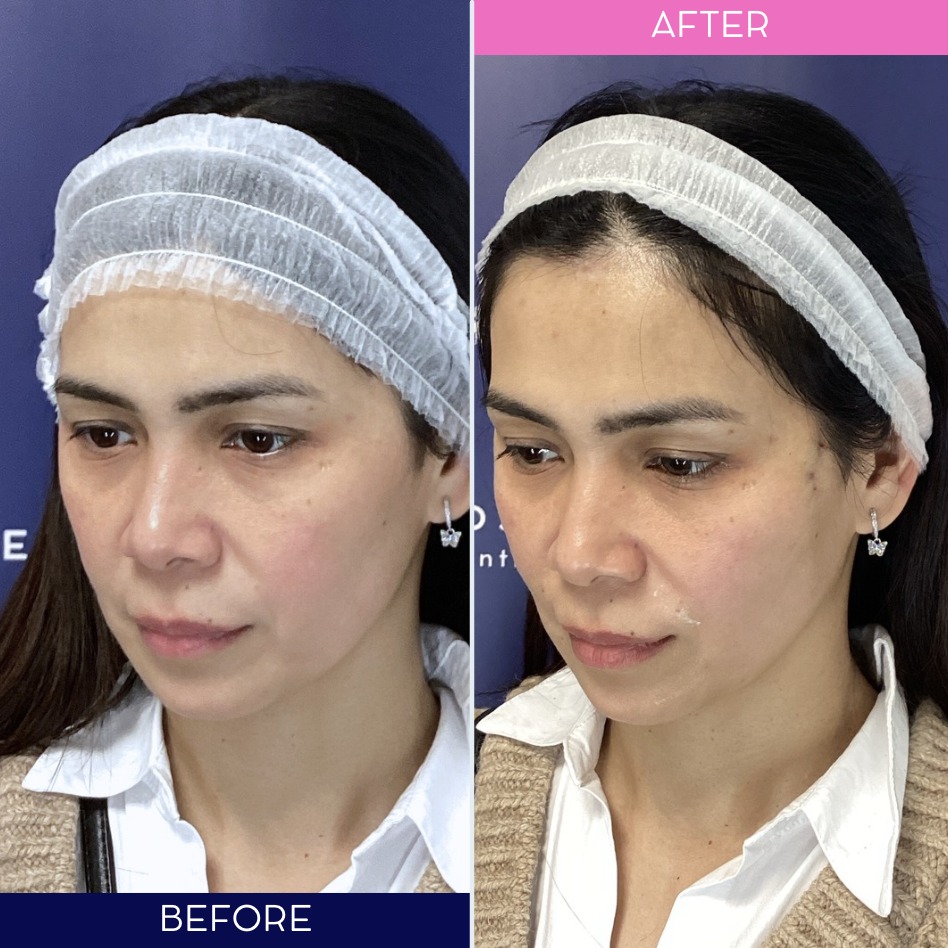 The Cosmetic - Before & After: The Art of Subtle Lift. Our thread lift ...