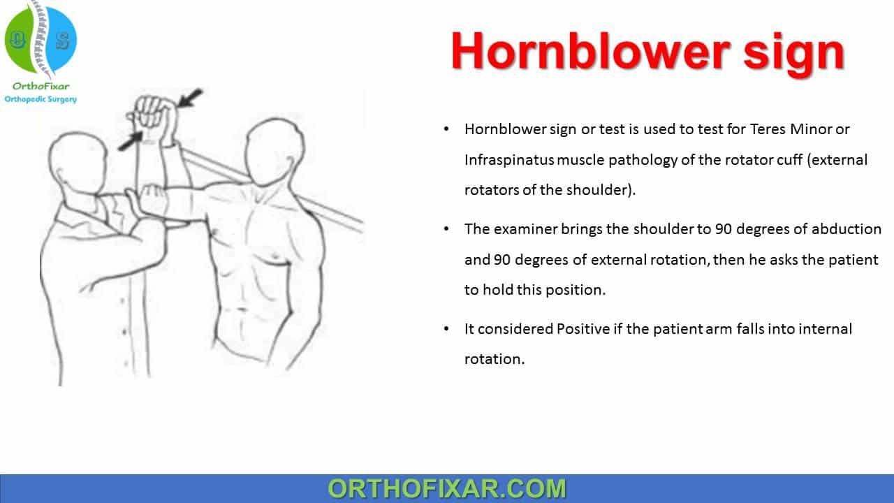 Hornblower Sign -... - OrthoFixar - Orthopedic Surgery | Facebook