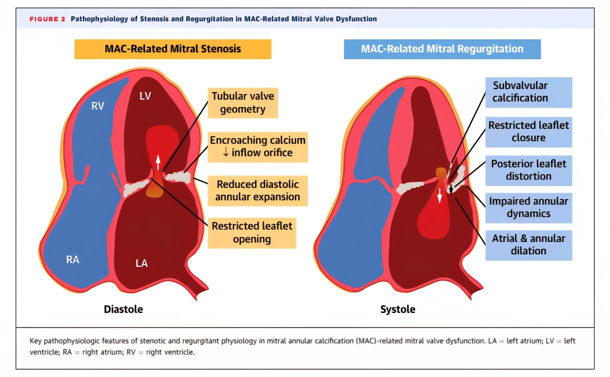 #Mitral #Valve #Annular... - Cardiologia Siglo XXI | Facebook