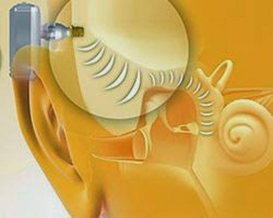 implant-zakotwiczone-kostny-facebook