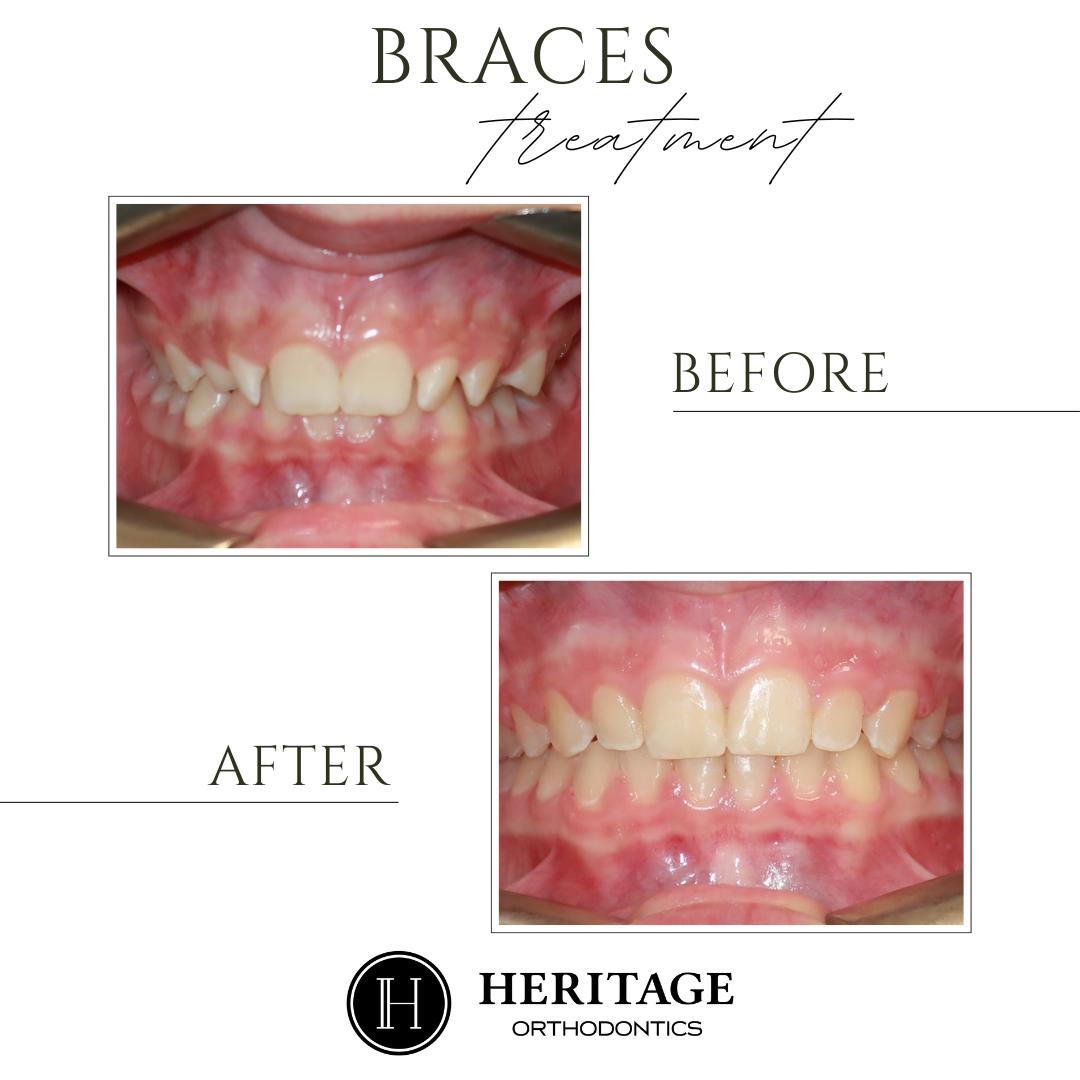 Heritage - 🦷 Transformation Thursday! 🦷 Smile Story: The Return of the ...