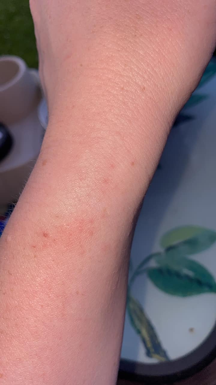 Has anyone experienced autoimmune rash from semaglutide?