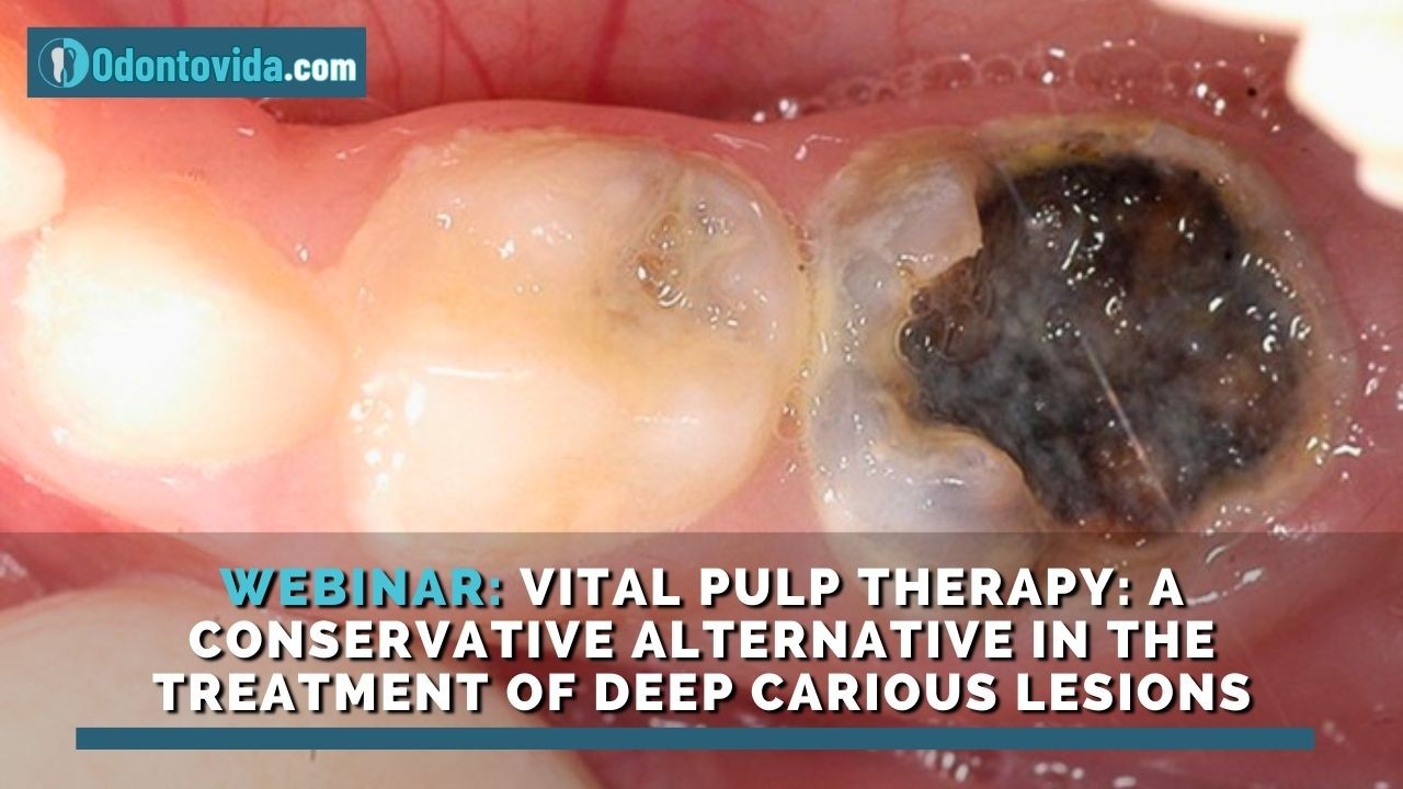Vital pulp therapy for deep carious lesions