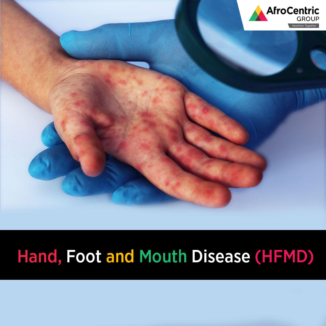 AfroCentric - Hand, Foot and Mouth Disease: What You Need to know Hand ...