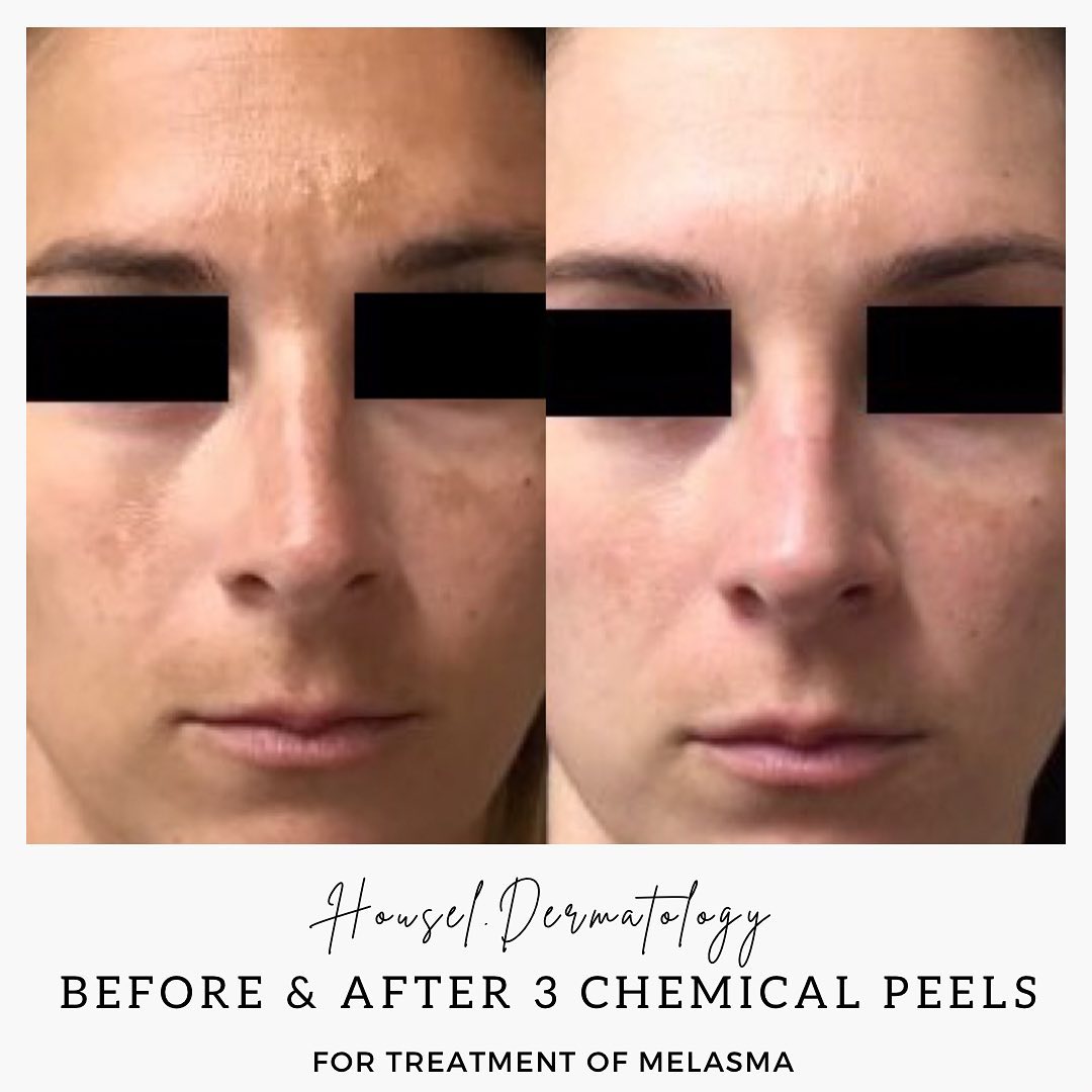 CHEMICAL PEELS • treat a... - Housel Dermatology, P.C. | Facebook