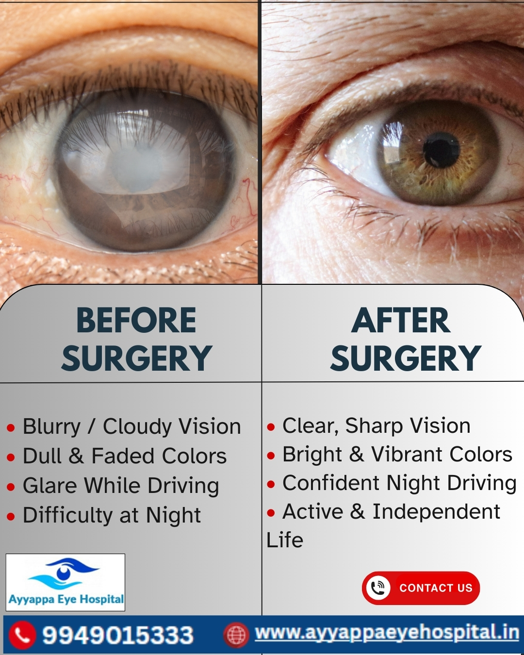 glutathione eye drops change eye color Is your vision getting blurry or cloudy? It could be Cataract. 🔎 Before Cataract Surgery: ▪️ Blurred or hazy vision ▪️ Faded & dull colors ▪️ Difficulty driving at night ▪️ Sensitivity How Pinealon Might Improve Size:2 Ounce 3-Pack type:body-scrub
