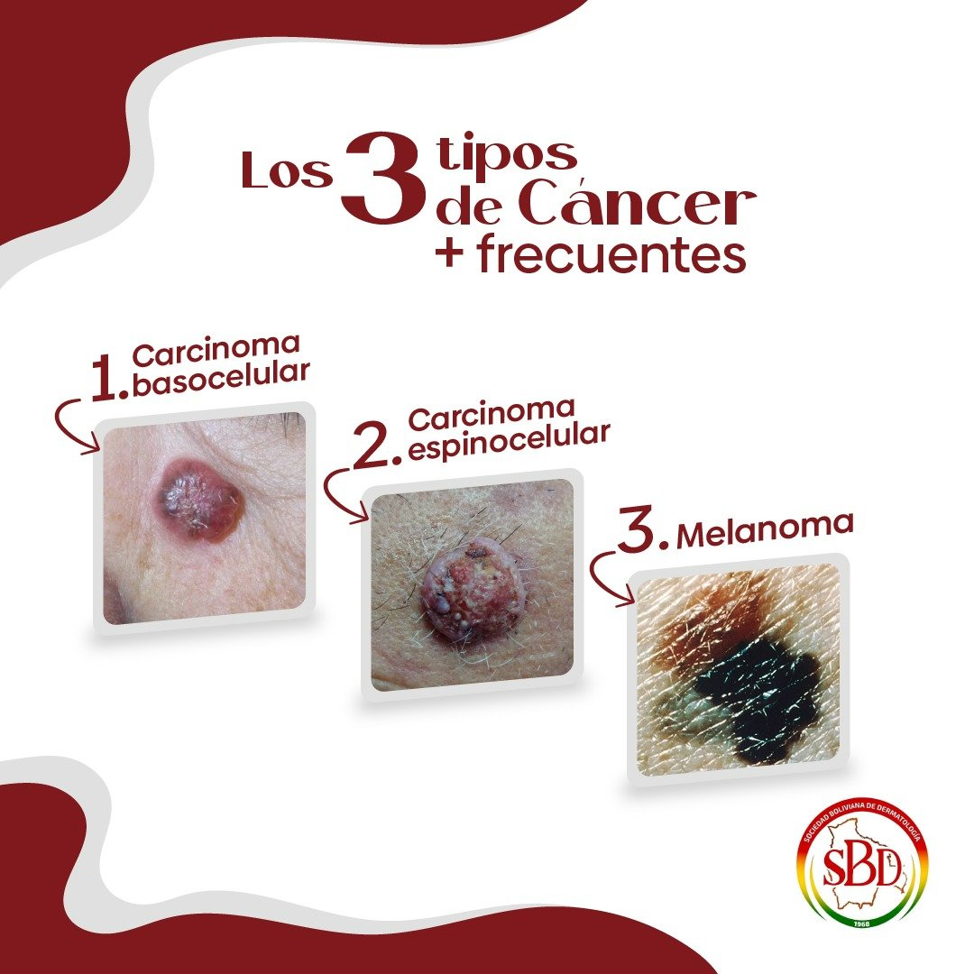 Sociedad - Aquí te compartimos los 3 tipos de cáncer de piel más ...