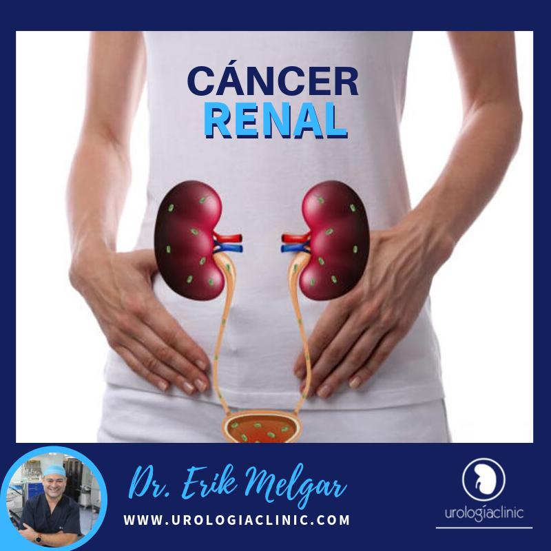 Urología - El cáncer renal tiene su origen en las células de los ...