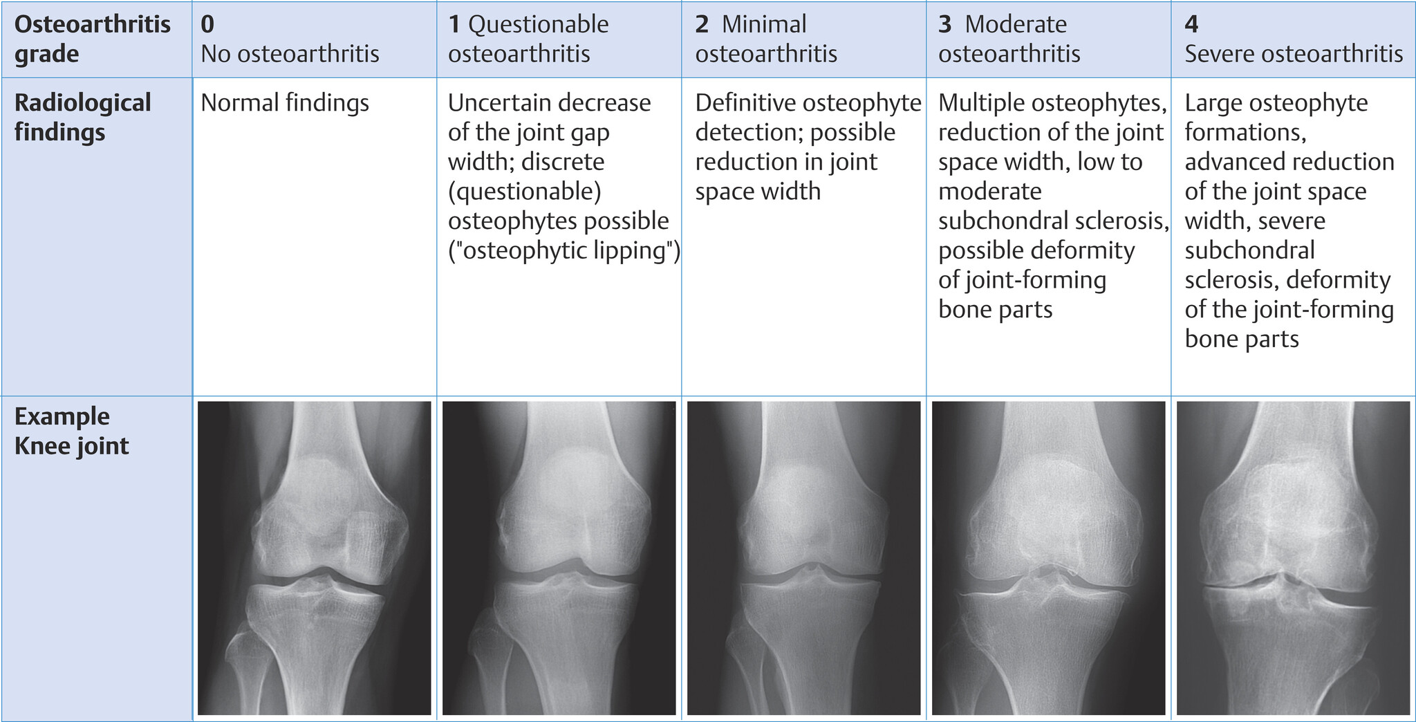 Ayman - Classification according to Kellgren and Lawrence based on the ...