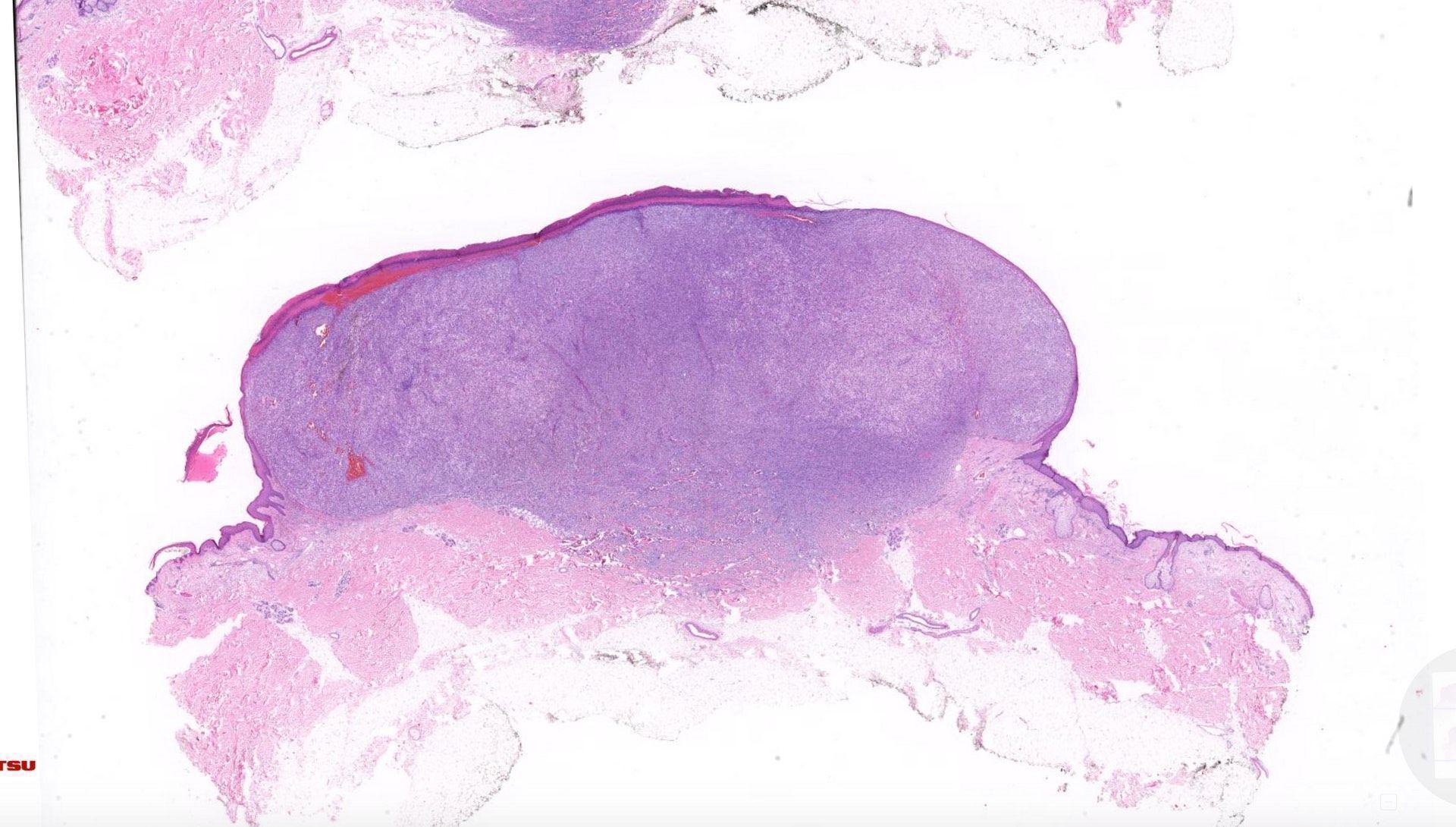 Jerad - 65 yo man with rapidly growing ulcerated black nodule on back ...