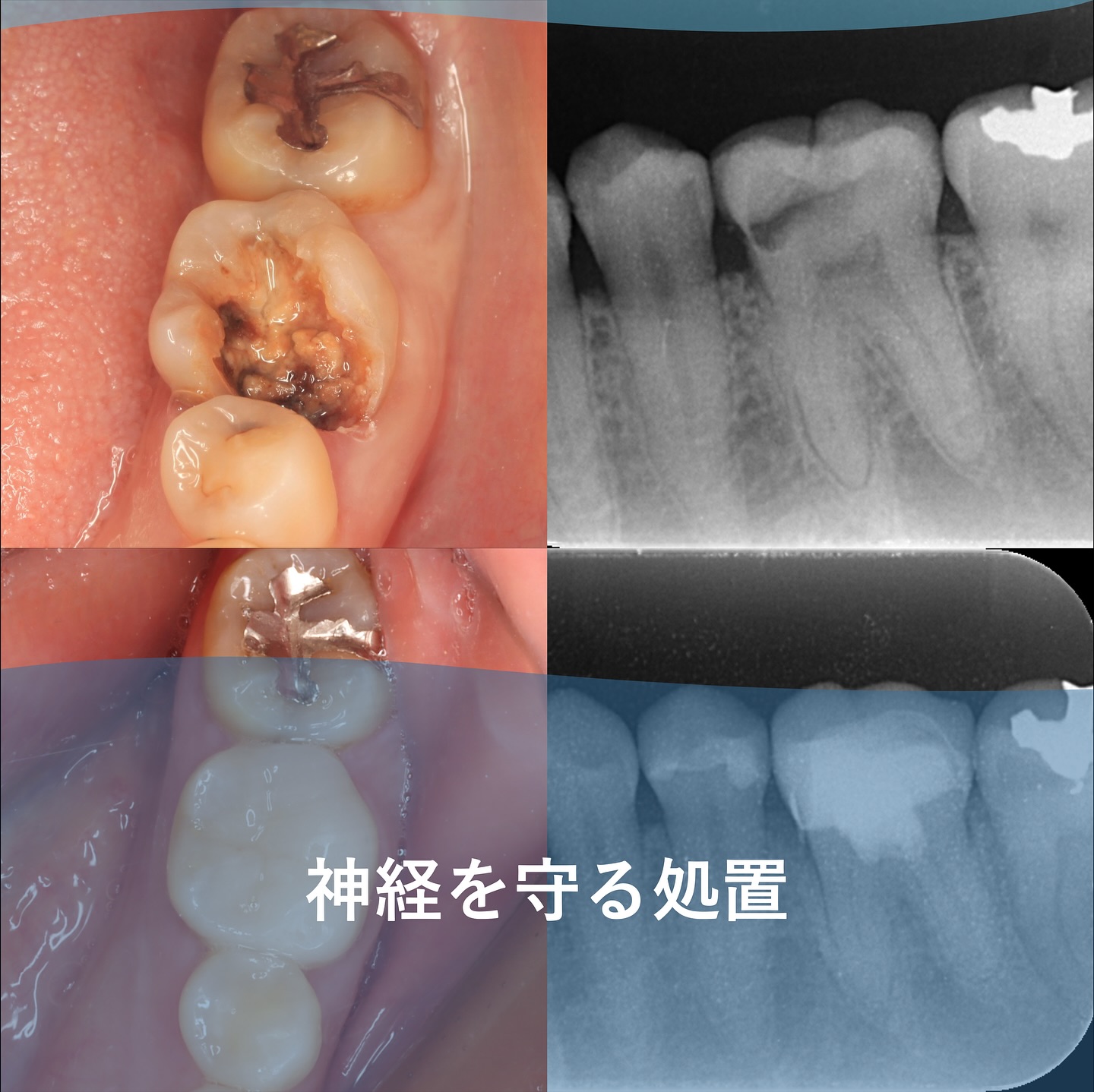 生活歯髄療法 VPT(Vital pulp therapy)」
