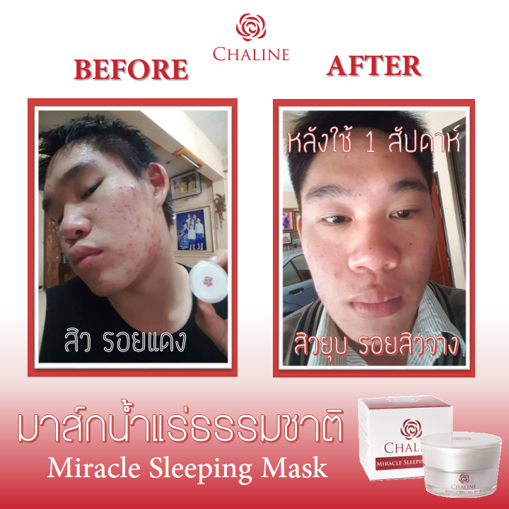 #สิวยุบ #รอยสิวจางลง... - Chaline Skincare - ชาลีน สกินแคร์