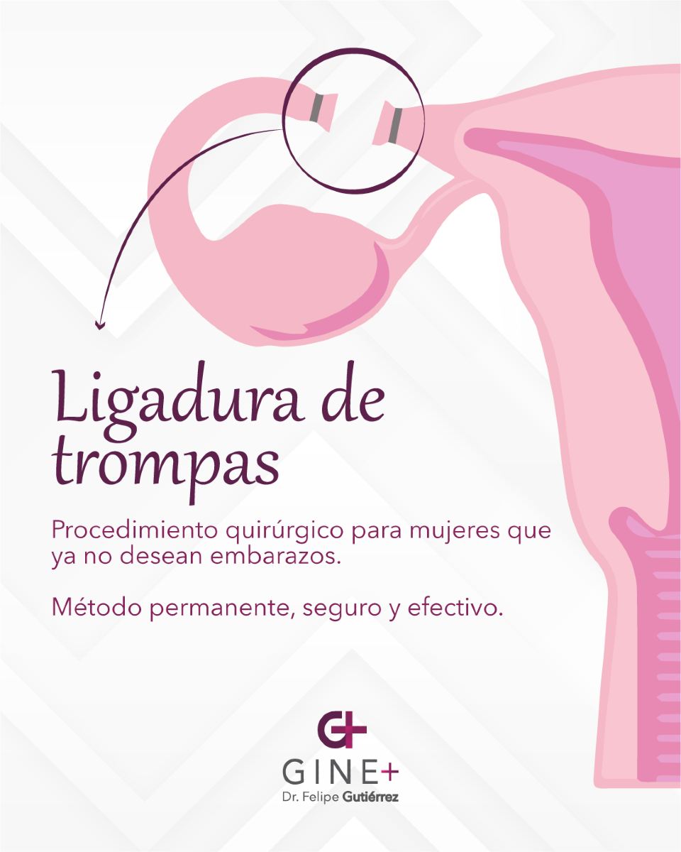 Gine + - La ligadura de trompas es un procedimiento... | Facebook