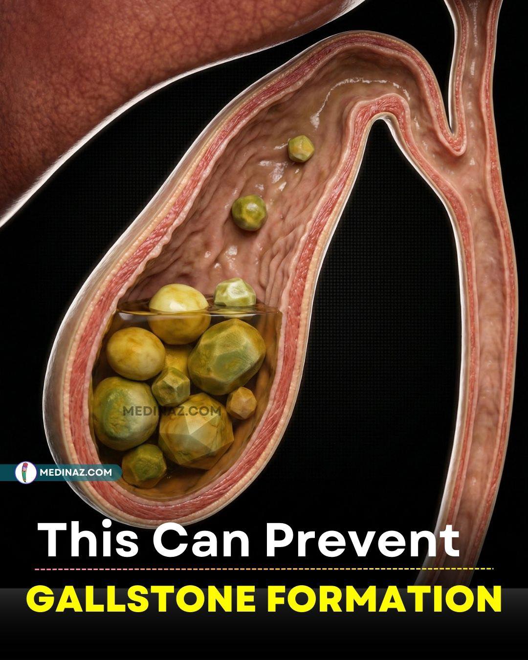 Gallstones often develop without warning. Early awareness and preventive habits can help reduce long-term risk. Book your appointment today for expert care and quick assistance. Call or WhatsApp at +91 98710-99766 # Gallstones #