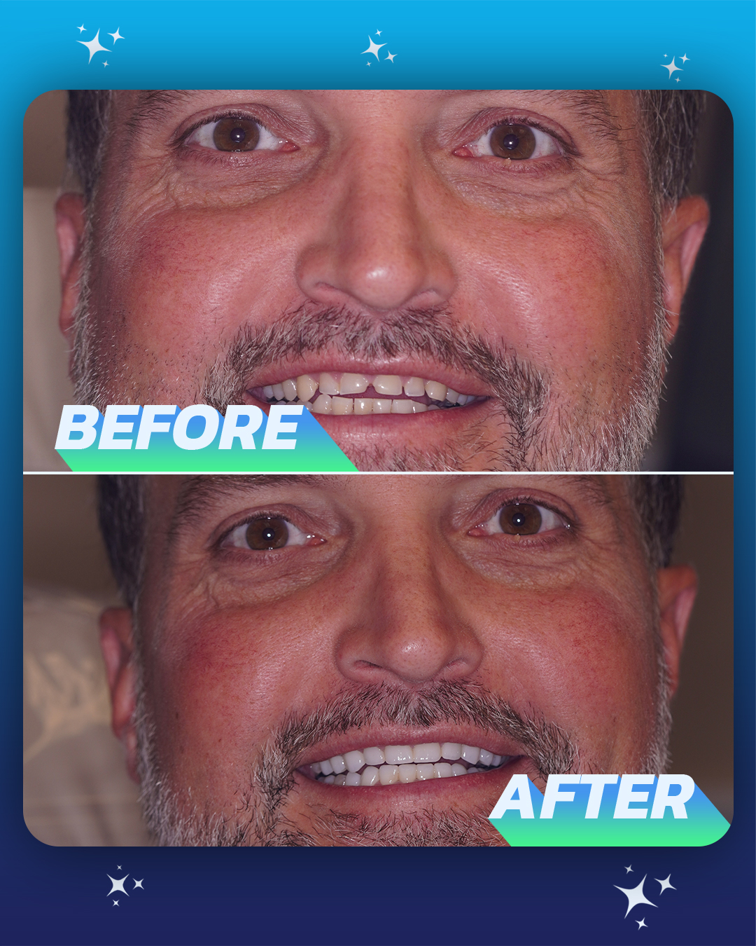 🇺🇸 Getting a new smile 🙌 This patient... - The Smile Mission | Facebook