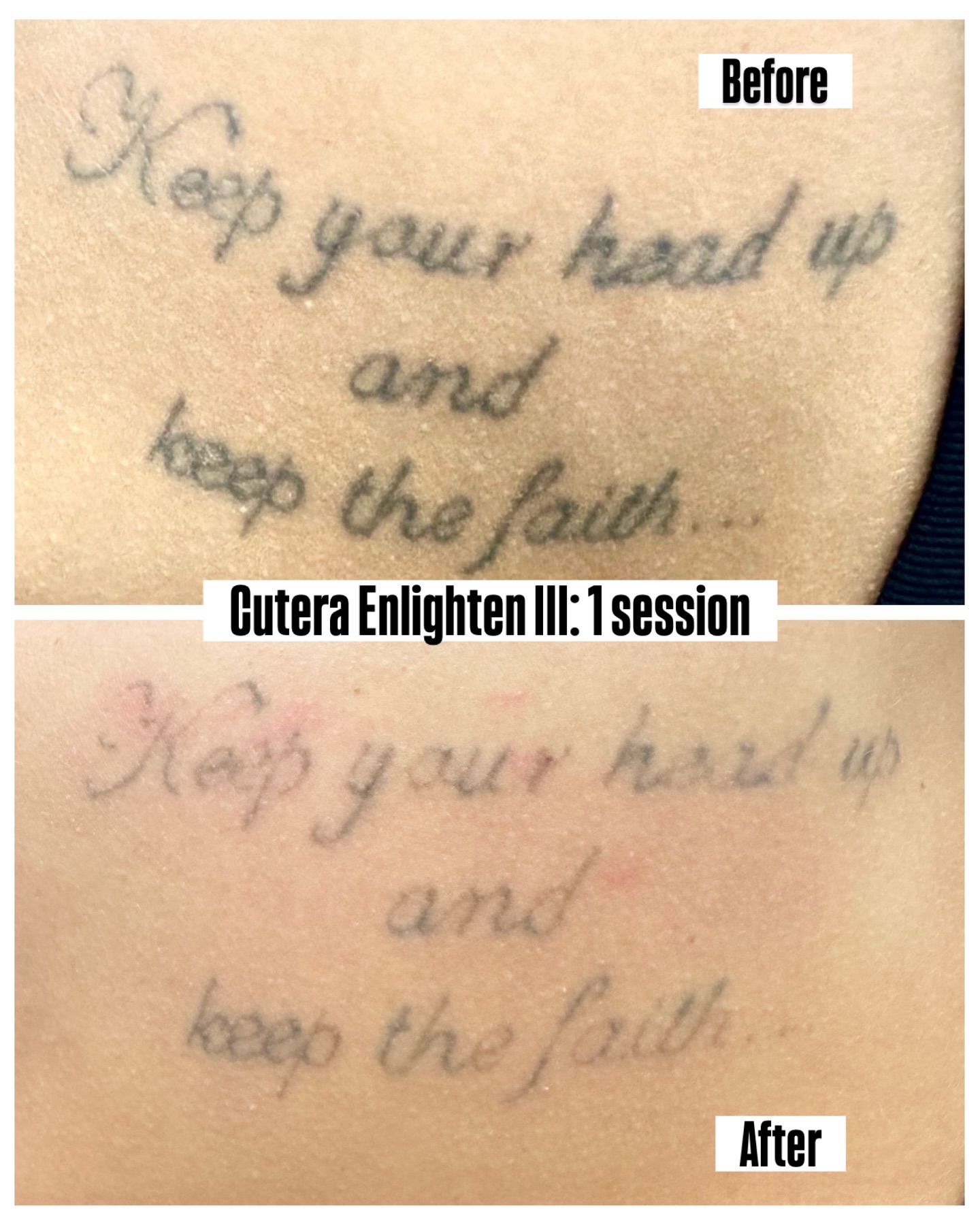 Ink - Just ONE session with the Cutera Enlighten III and we’re already ...