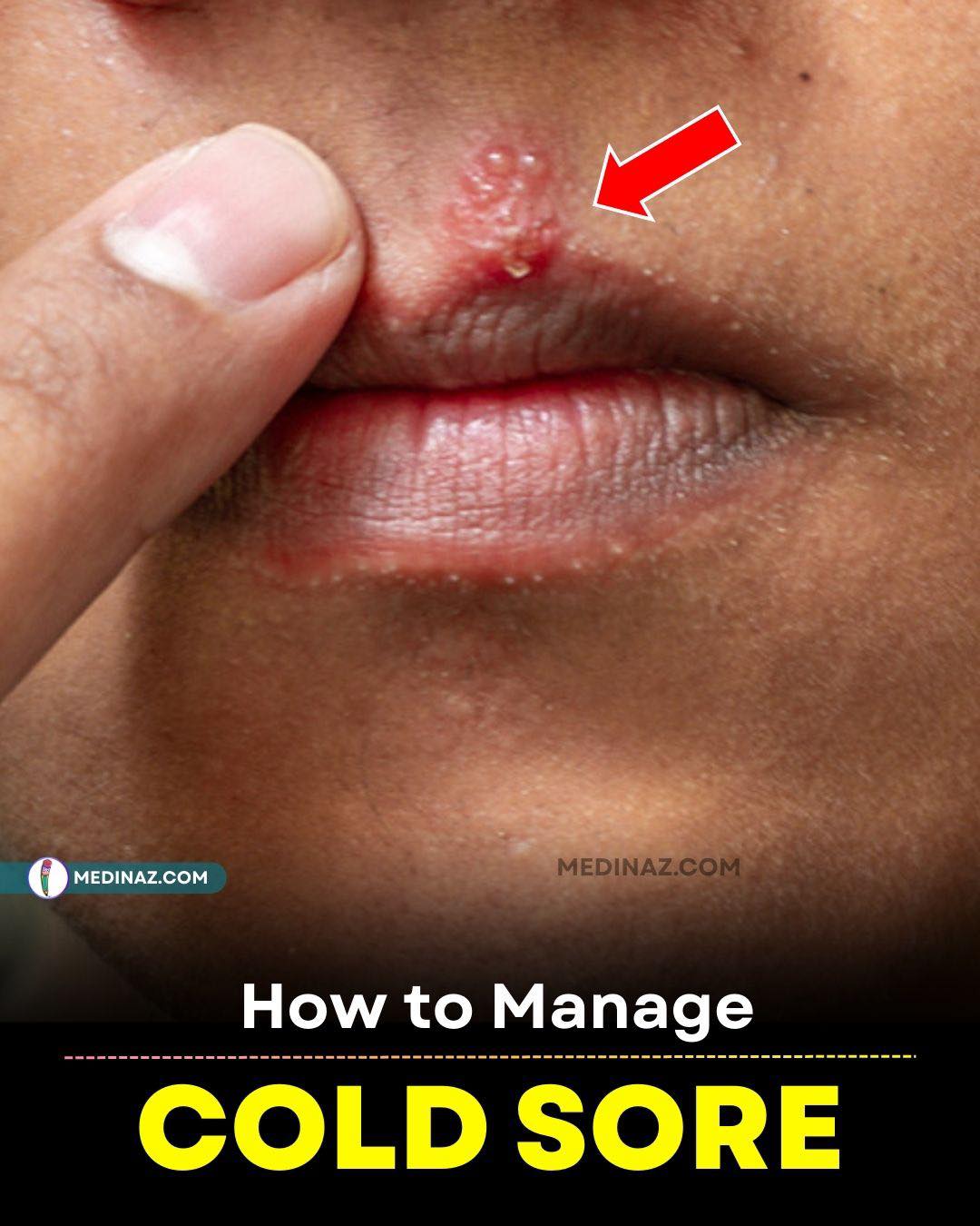 semaglutide and cold sores Online Sore Medication Prescriptions & Treatment Compounded Sublingual Semaglutide Drops for