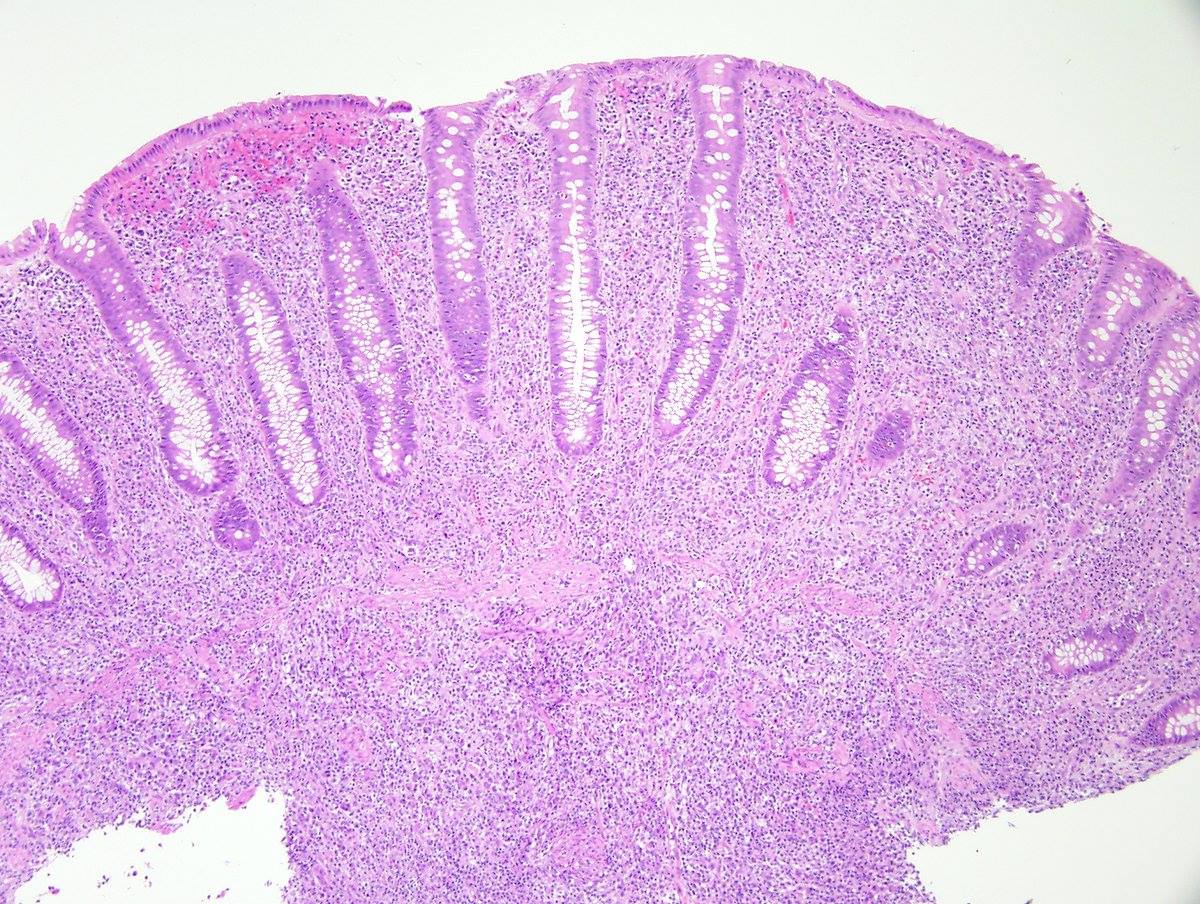 USCAP - Examples of syphilis proctitis mimicking chronic...