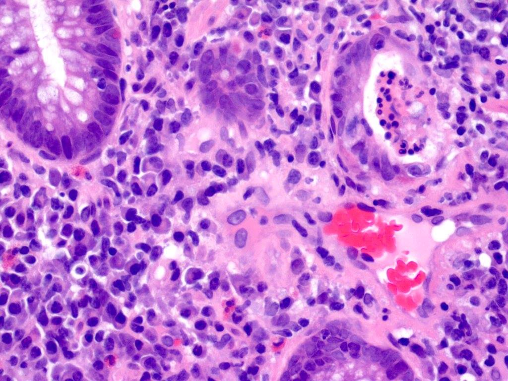 USCAP - Examples of syphilis proctitis mimicking chronic...