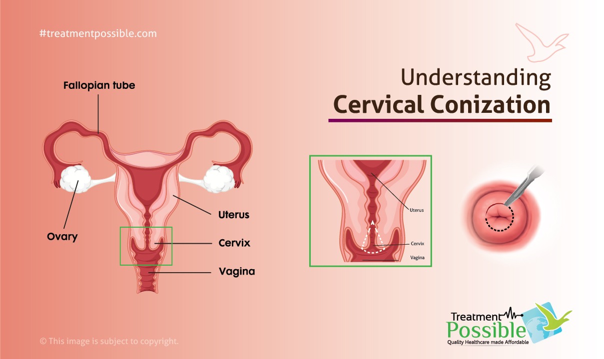 #Conization for #Cervical #Cancer: It... - Treatment Possible | Facebook