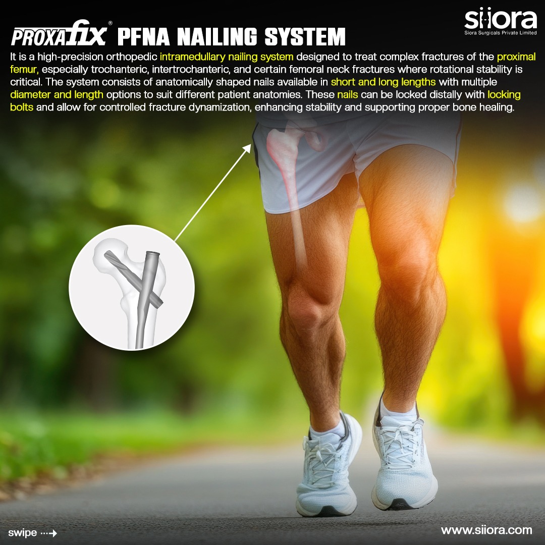 🦴 Advanced Fixation for Proximal... - Siora Surgicals Pvt Ltd | Facebook