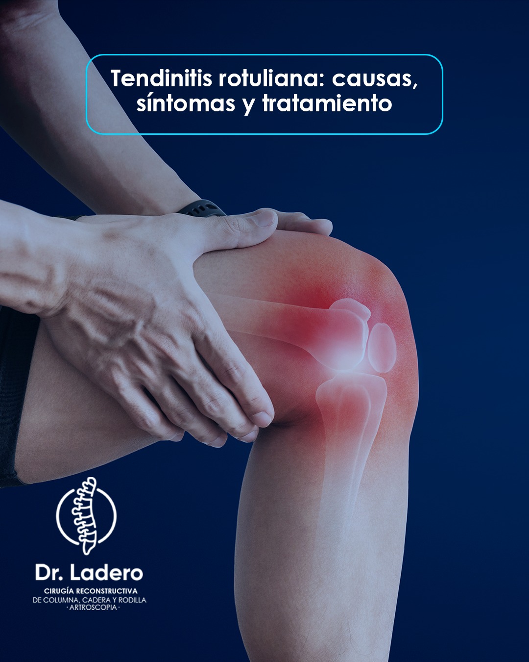 Dr. - 📌 Tendinitis Rotuliana: causas, síntomas y tratamiento La ...