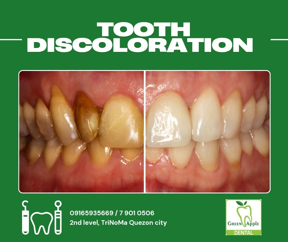 Green - Tooth discoloration? 😁 Don't worry, we've got you! 😊 Tooth ...