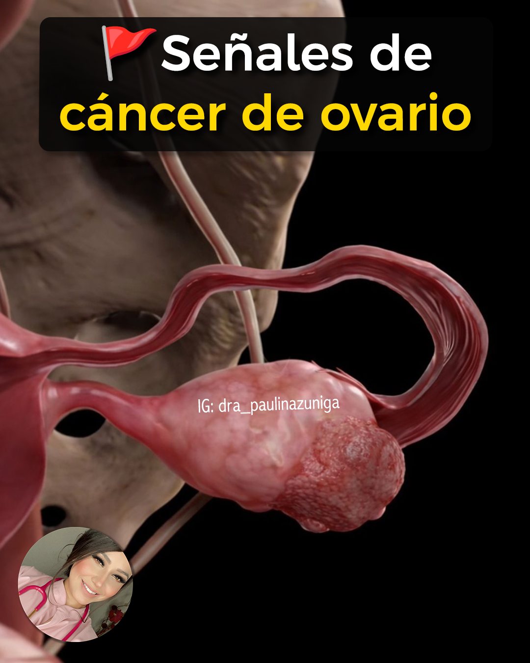 Dra. - 🩺 Cáncer de ovario: cuando los síntomas hablan en voz baja ...