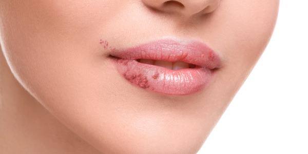 Revista Feridas Herpes Labial E Genital Infectologista Explica Sintomas E Tratamentos De Acordo Com A Organizacao Mundial Da Saude Oms Dois Tercos Dos Individuos Com Menos De 50 Anos De Idade
